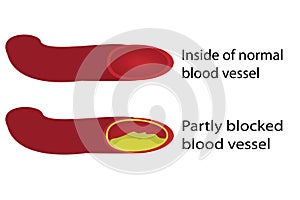 Healthy and blocked blood vessels