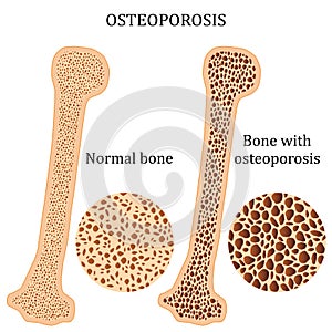 Healthy bone and osteoporosis bone. photo