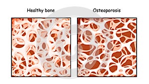 Healthy bone and Osteoporosis in comparison isolated on a white background