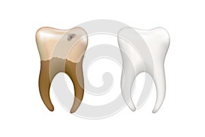 Healthy bright human tooth and old dirty tooth with caries isolated on white, dental health concept illustration