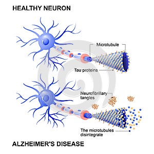 Healthy cell and neurons with Alzheimer`s disease. Tau hypothesi