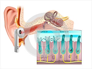 Healthy and damaged hair cells inside cochlea. Tinnitus. Noise-induced hearing loss. .