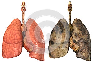 Lungs of a smoker photo