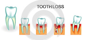 Healthy and diseased tooth. bleeding gums. tooth loss