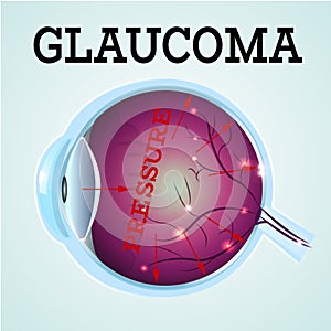 Healthy Eye Glaucoma