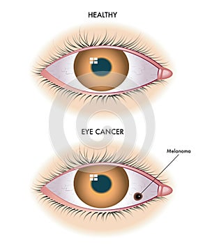Zdravý oko a melanóm 