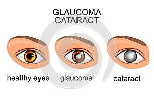 Healthy eyes, glaucoma, cataracts