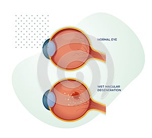 Healthy Eyes vs Wet Macular Degeneration - Stock Illustration photo