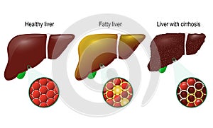 Healthy, fatty and cirrhosis of the liver photo