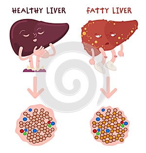 Healthy and fatty liver difference. FLD. Hepatic steatosis.