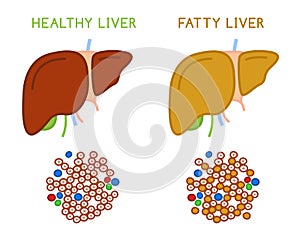 Healthy and fatty liver. Medical vector infographic. photo