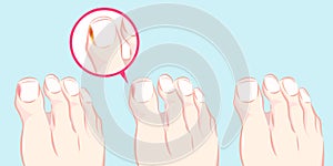 Healthy foot and ingrown nail