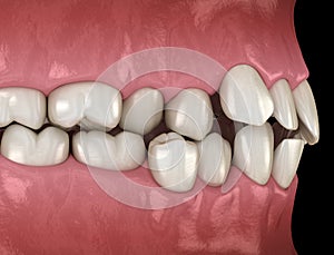 Healthy human teeth with normal occlusion, side view. Medically accurate tooth illustration photo