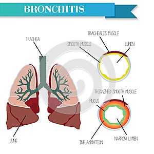 Healthy and inflamed bronchus. Chronic Bronchitis. photo