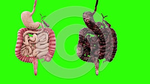 Healthy intestines and disease intestines on green screen rotate. Autopsy medical concept. Cancer and smoking problem.