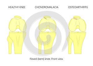 Healthy knee, Chondromalacia and Patellofemoral osteoarthritis
