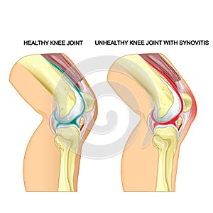 A healthy knee joint and unhealthy knee joint with synovitis. Vector photo