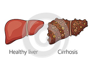 Healthy liver and cirrhosis disease schematic