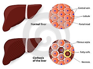 Saludable hígado a cirrosis 