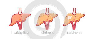 Healthy liver and tumor damaged illustration. Process transformation normal organ into fatty hepatosis and cirrhosis.