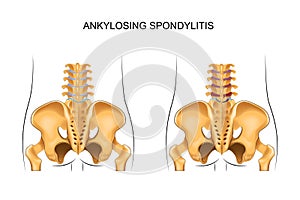 Healthy lower back and ankylosing spondylitis