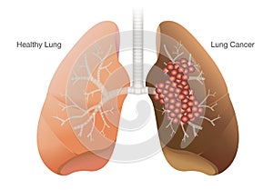 Healthy lung and cancer lung photo