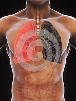 Healthy Lung and Smokers Lung