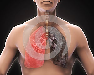 Healthy Lung and Smokers Lung