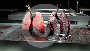 Healthy lungs and disease lungs on morgue table. Autopsy medical concept. Cancer and smoking problem.