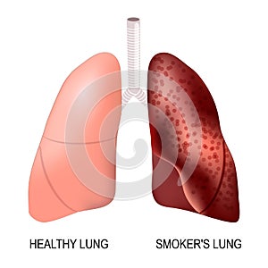 Healthy lungs and smokers lungs