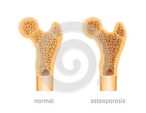 Healthy and osteoporosis human bone