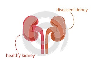 Healthy and painful kidney clipart. Pink clear parenchyma working organ and gray tumor covered ureter. photo