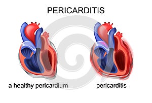 A healthy pericardium, pericarditis photo