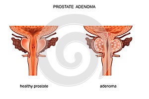 Healthy prostate and BPH