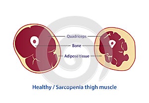 Healthy and sarcopenia thigh muscle vector illustration on white background. photo