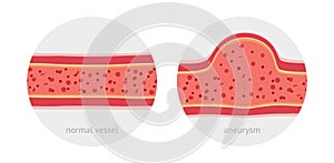 Healthy and sick aneurysm human vessel