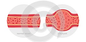 Healthy and sick aneurysm human vessel