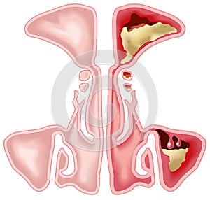 Healthy sinus and sinusitis, medical illustration photo