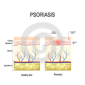 Healthy skin close up and skin with the plaque psoriasis