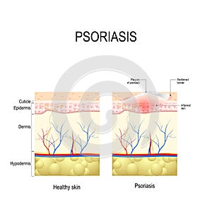 Healthy skin close up and skin with the plaque psoriasis photo