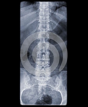 Healthy spine of a adult male on x-ray
