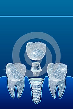 Healthy teeth and dental implant. Dentistry. Implantation of human teeth. illustration