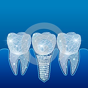 Healthy teeth and dental implant. Dentistry. Implantation of human teeth. illustration