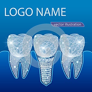 Healthy teeth and dental implant. Dentistry. Implantation of human teeth. Vector illustration