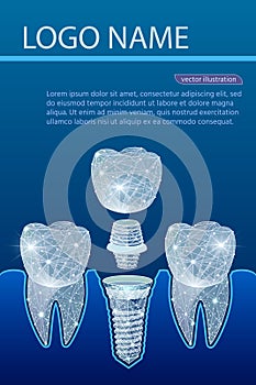 Healthy teeth and dental implant. Dentistry. Implantation of human teeth. Vector illustration