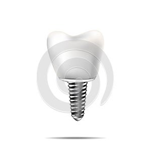 Healthy teeth and dental implant. Realistic illustration of tooth medical dentistry.