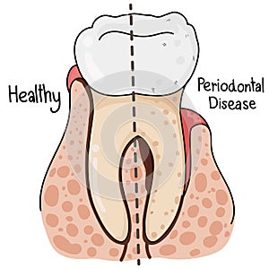 Healthy Teeth and Periodontal Disease.