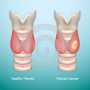 Healthy Thyroid and Thyroid Cancer. EPS10 Vector Illustration. photo