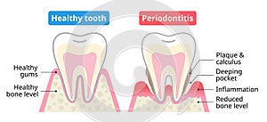 Healthy tooth and periodontal disease. Dental and oral health care concept.