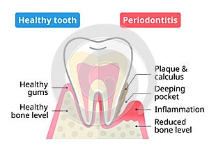 Healthy tooth and periodontal disease. Dental and oral health care concept